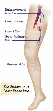 The Endovenous Laser Procedure for Leg Veins