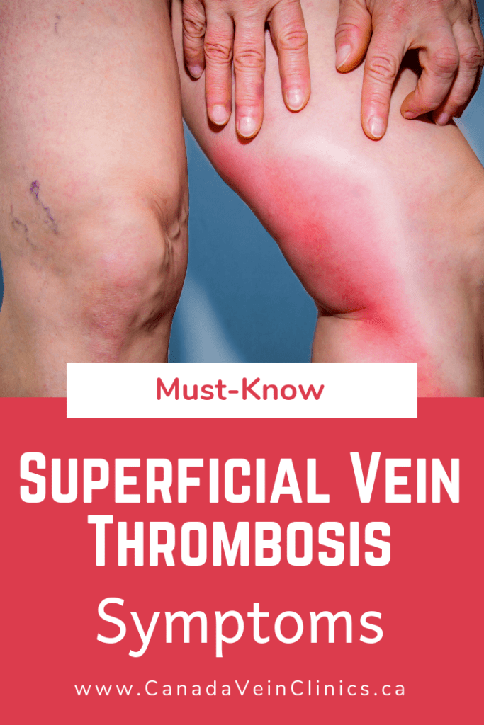 Superficial Vein Thrombosis Complications of Varicose Veins