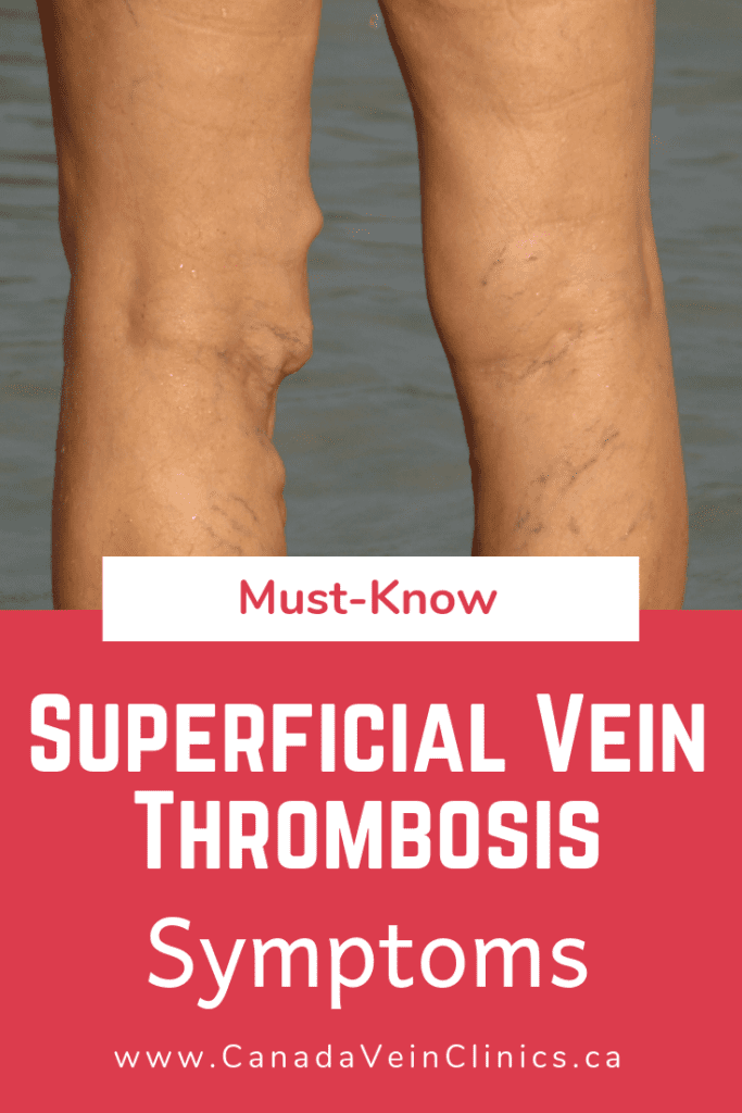 Superficial Venous Thrombosis