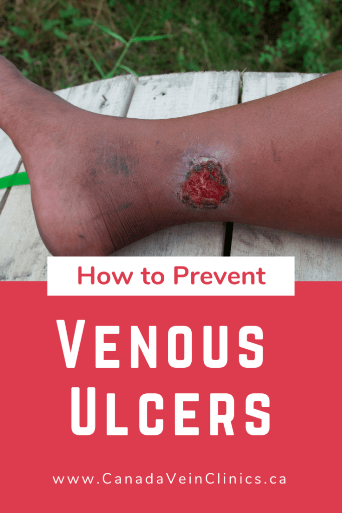 Venous ulcers are open wounds